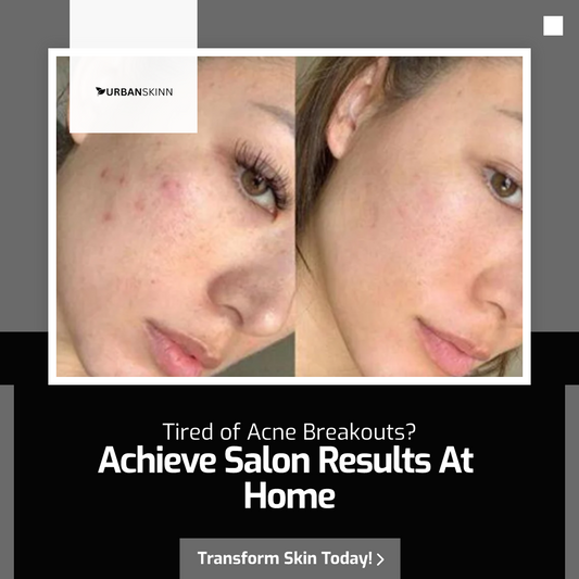 The Ultimate Guide to Anti-Acne Treatment at Home with Advanced Skincare Devices
