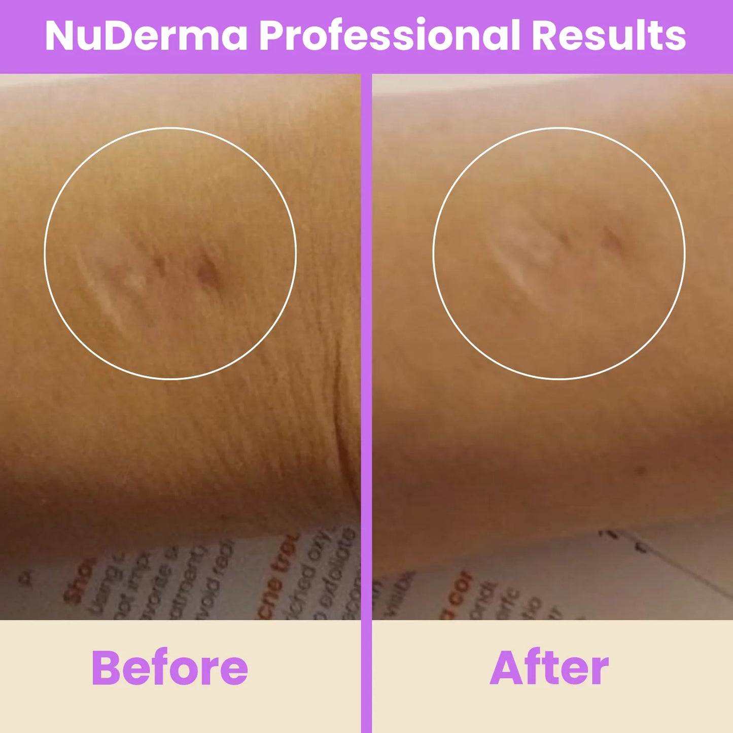NuDerma Professional High Frequency Wand