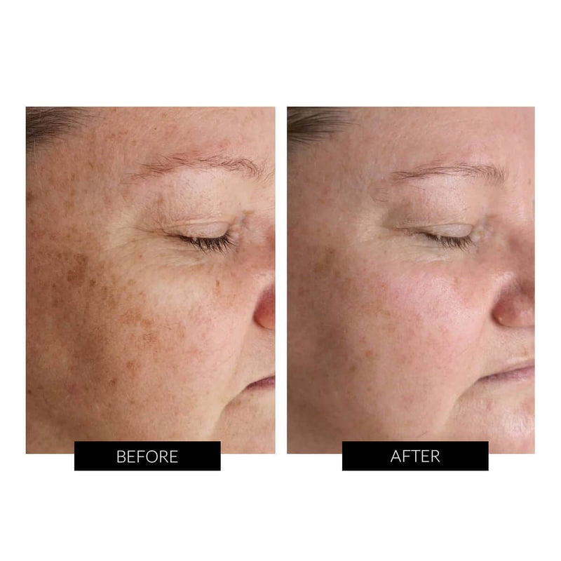 Dermalux Flex MD LED Light Therapy Device | Urban Skinn