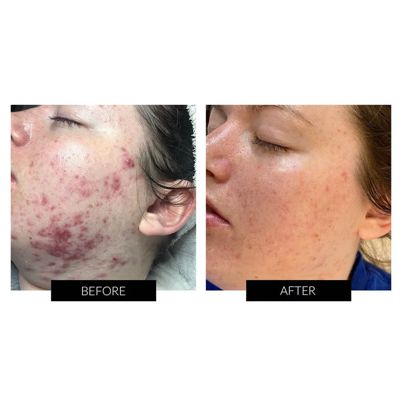 Dermalux Flex MD LED Light Therapy Device | Urban Skinn