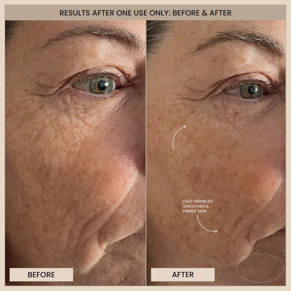 Evenskyn Before and after comparison of skin treatment on a person's face.