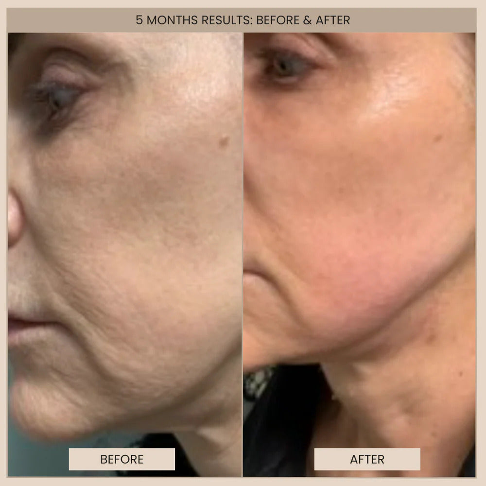 evenskyn lumo 5 moths before and after