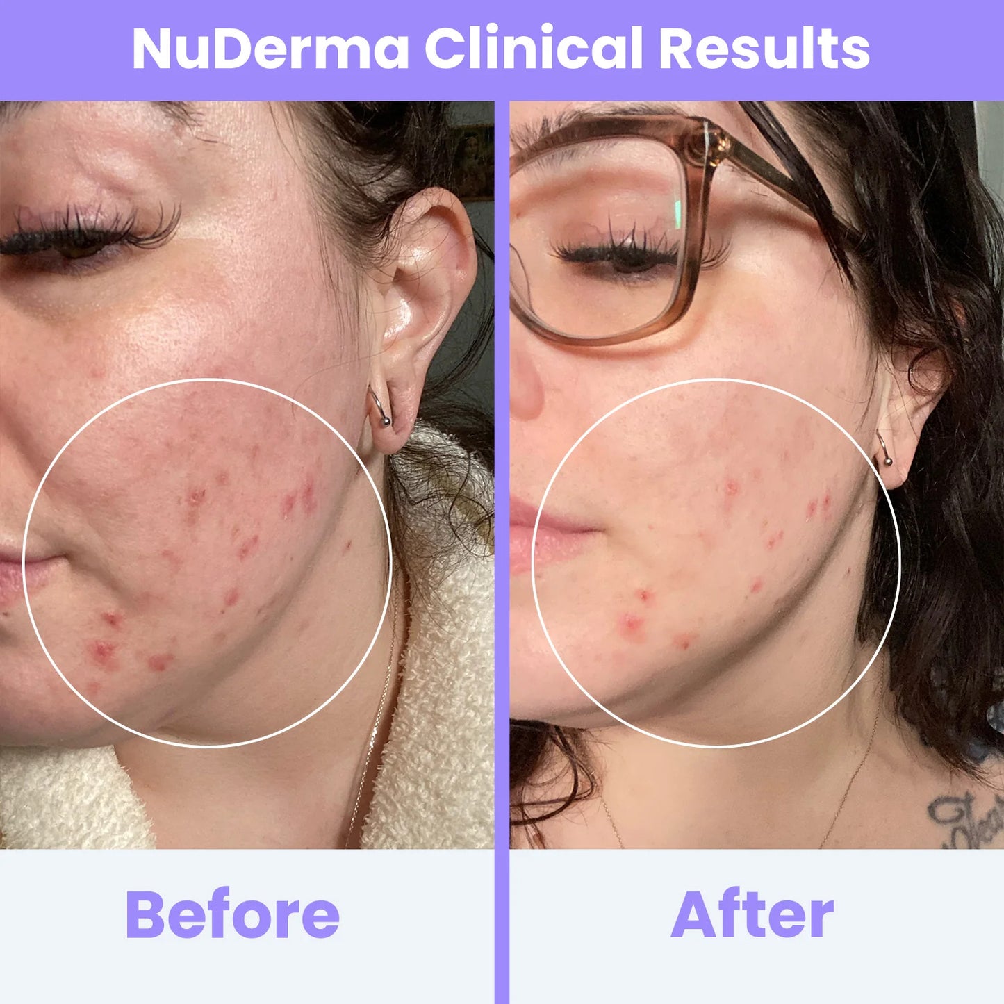 Nuderma Clinical High Frequency Wand | Professional Facial Therapy Machine for Clear, Radiant Skin