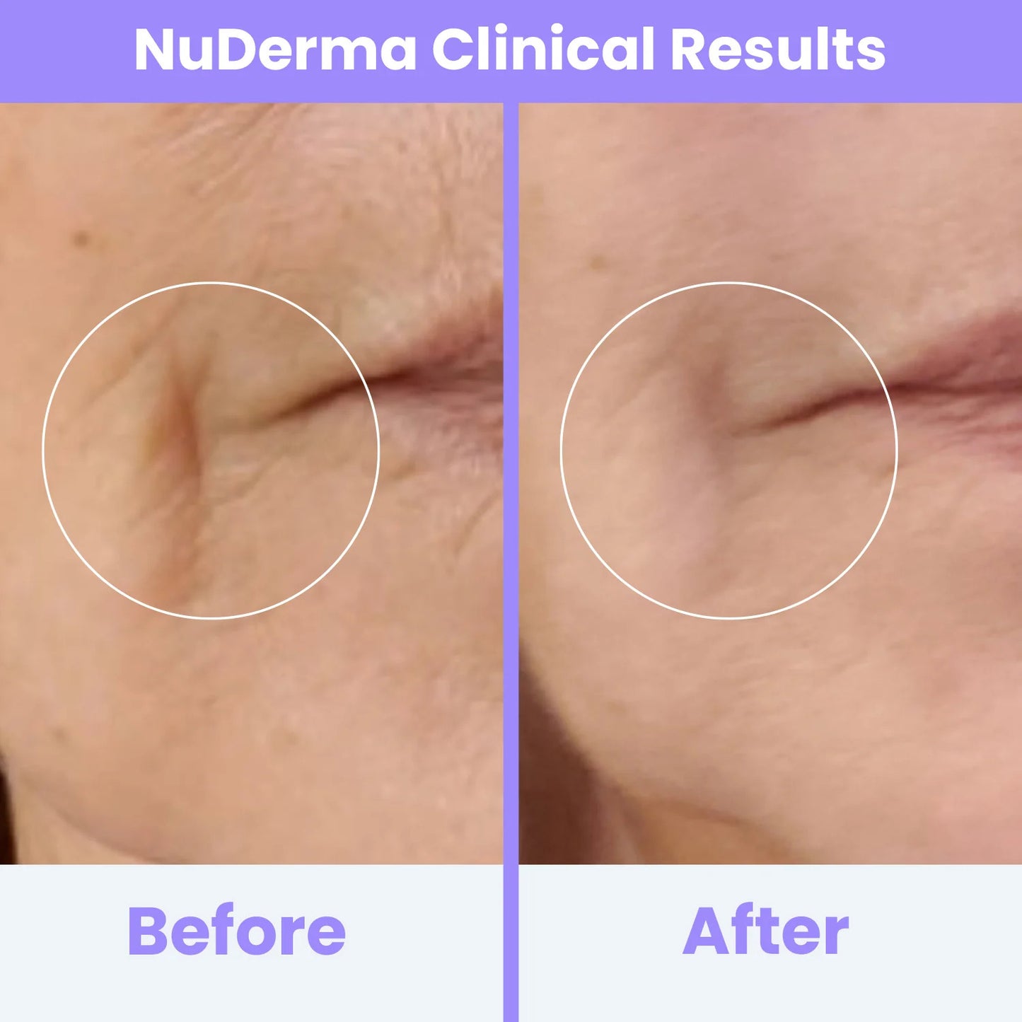Nuderma Clinical High Frequency Wand | Professional Facial Therapy Machine for Clear, Radiant Skin
