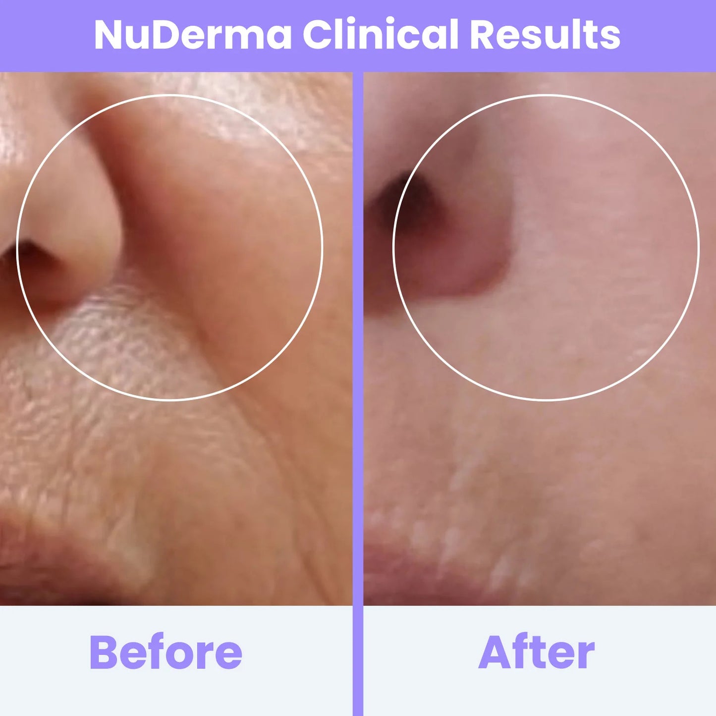 Nuderma Clinical High Frequency Wand | Professional Facial Therapy Machine for Clear, Radiant Skin