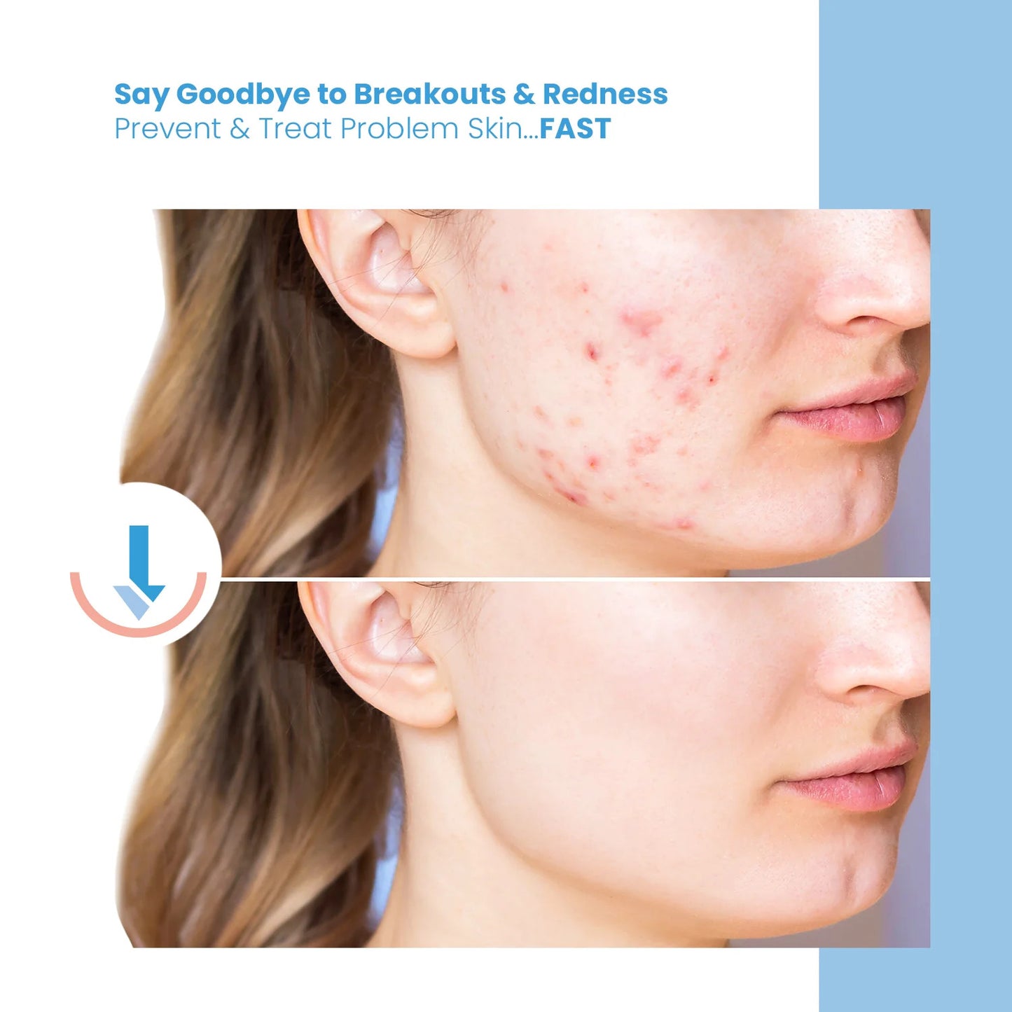 NuDerma High Frequency Wand acne treatment results before and after on chin