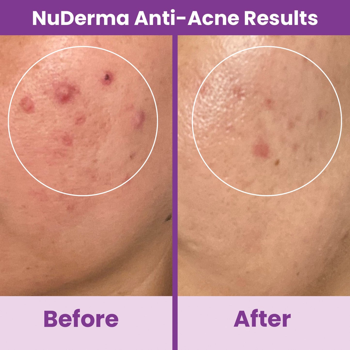 NuDerma High Frequency Wand before and after acne treatment results on cheek