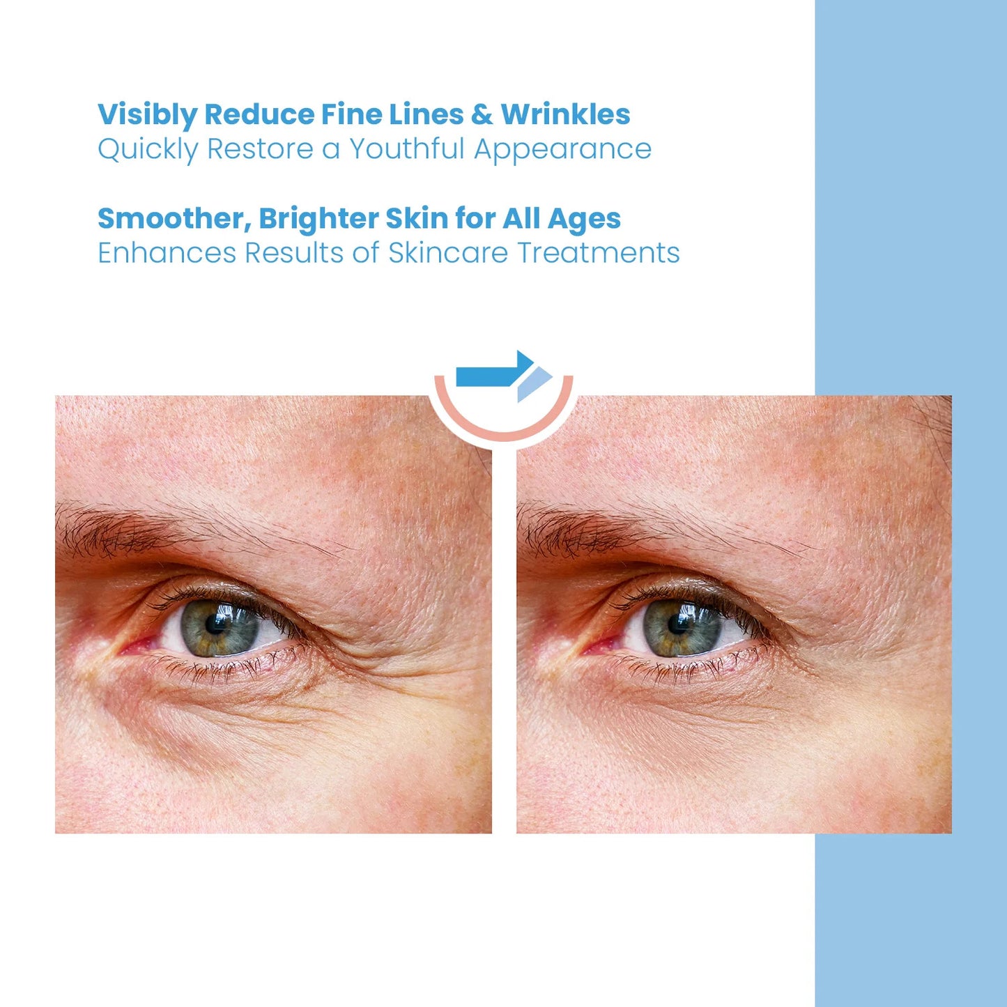 NuDerma High Frequency Wand before and after results for wrinkles around eyes