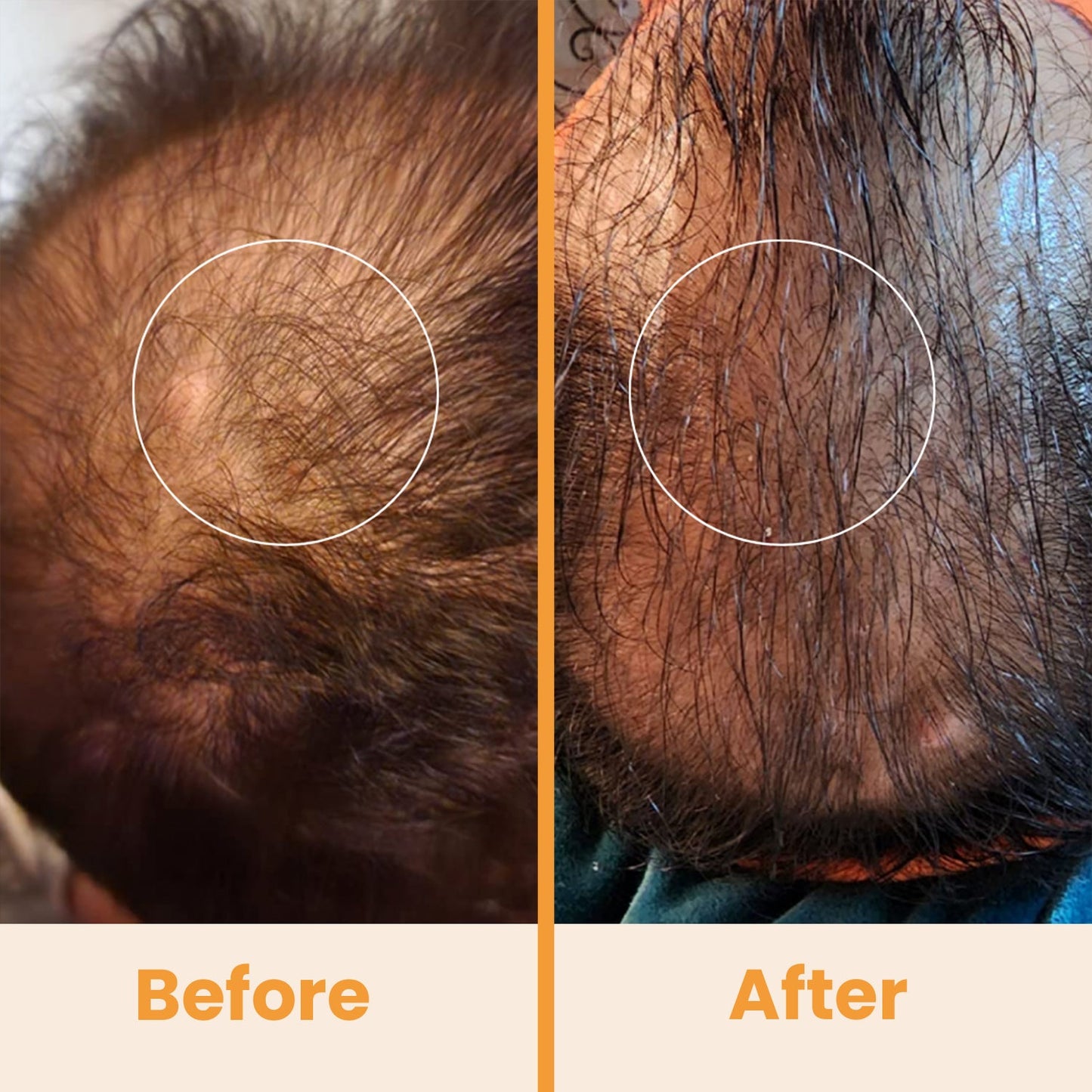 NuDerma High Frequency Wand before and after results for thinning hair scalp