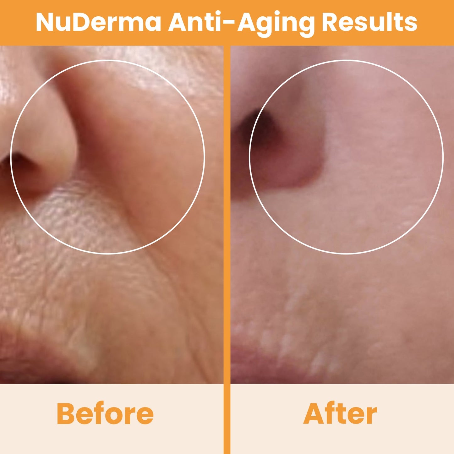 NuDerma High Frequency Wand anti-aging skin results for nose pores before after