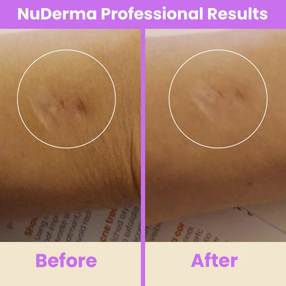 NuDerma Professional High Frequency Wand