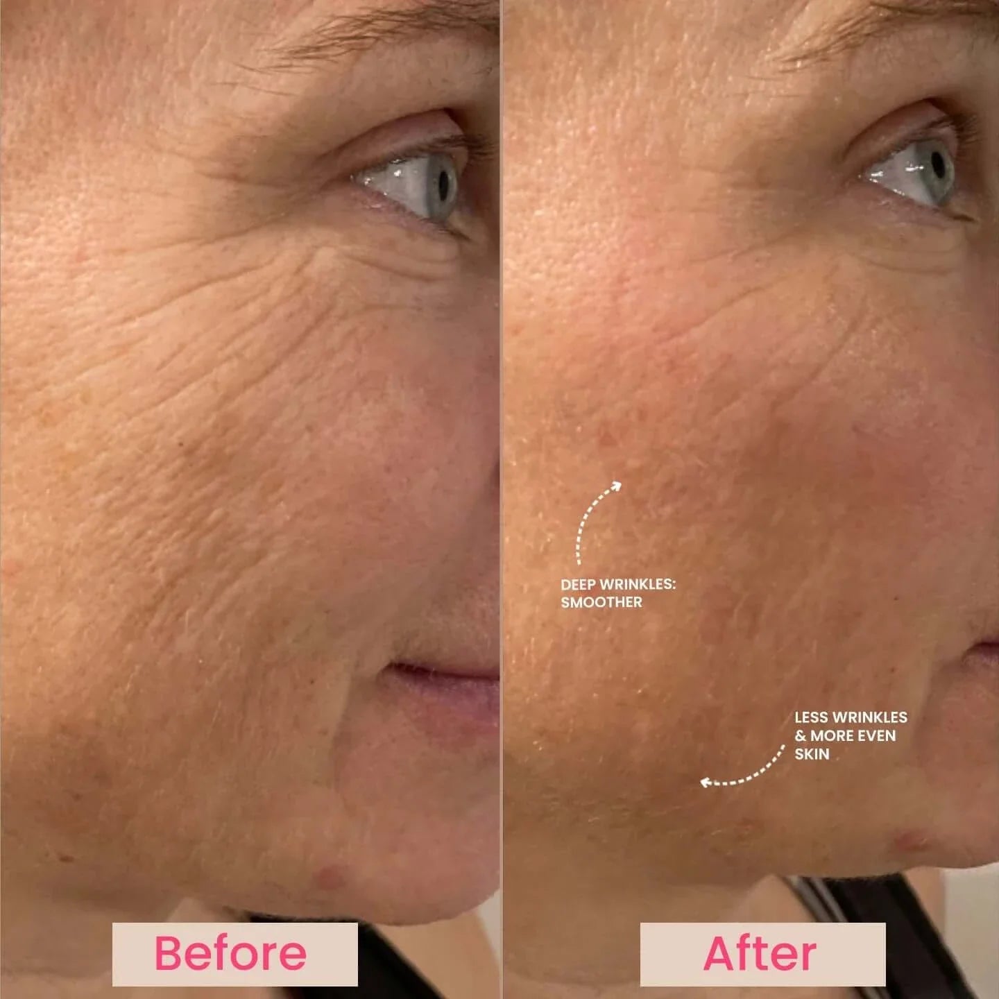 Urbanskinn® Lumo⁺: Premium Anti-Aging & Skin Tightening Handset