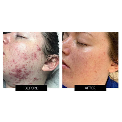 Dermalux Flex MD LED Light Therapy Device | Urban Skinn