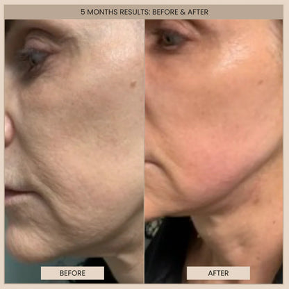 evenskyn lumo 5 moths before and after